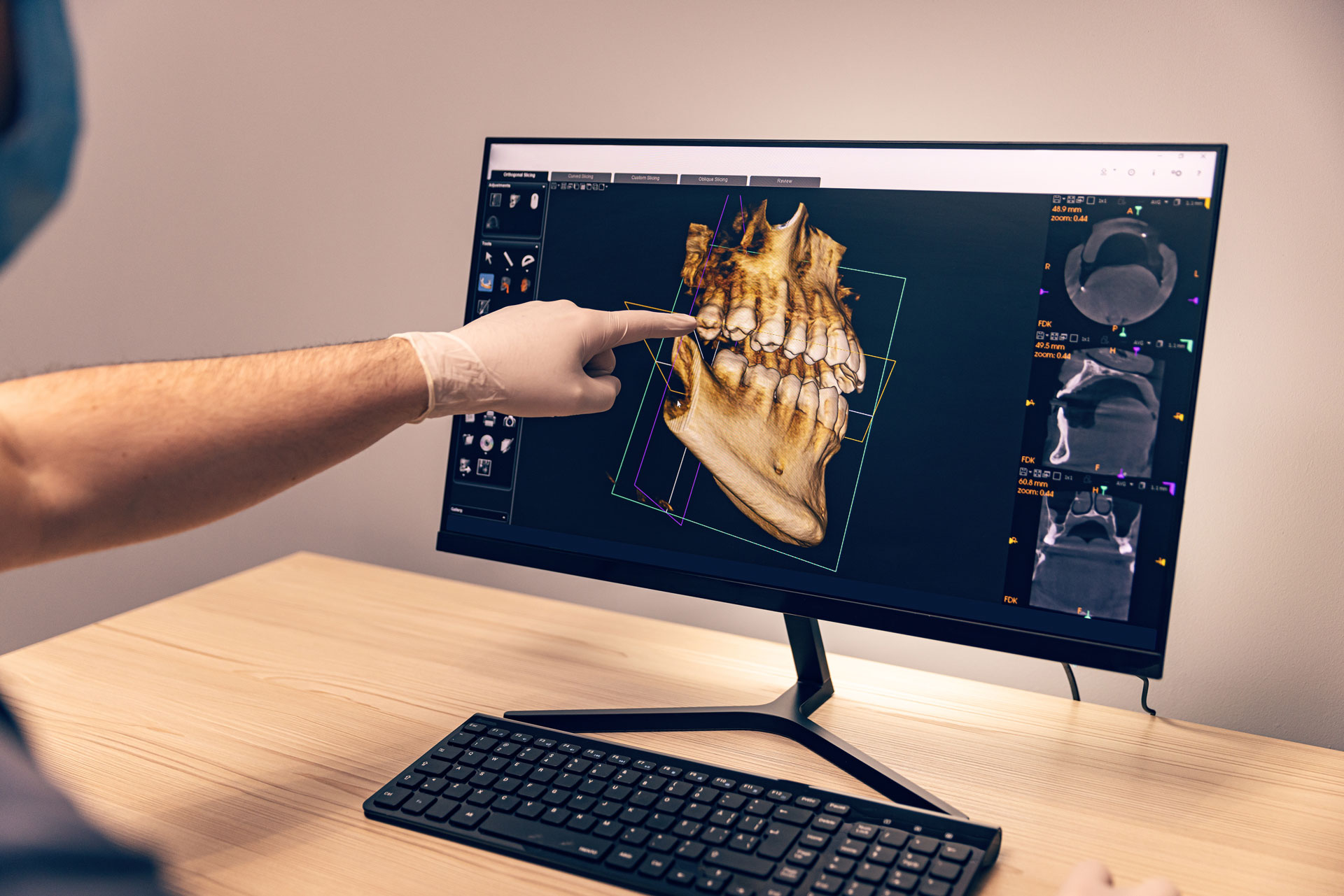 A gloved hand points at a 3D dental scan on a computer screen showing jawbone structure, highlighting bone grafting evaluation