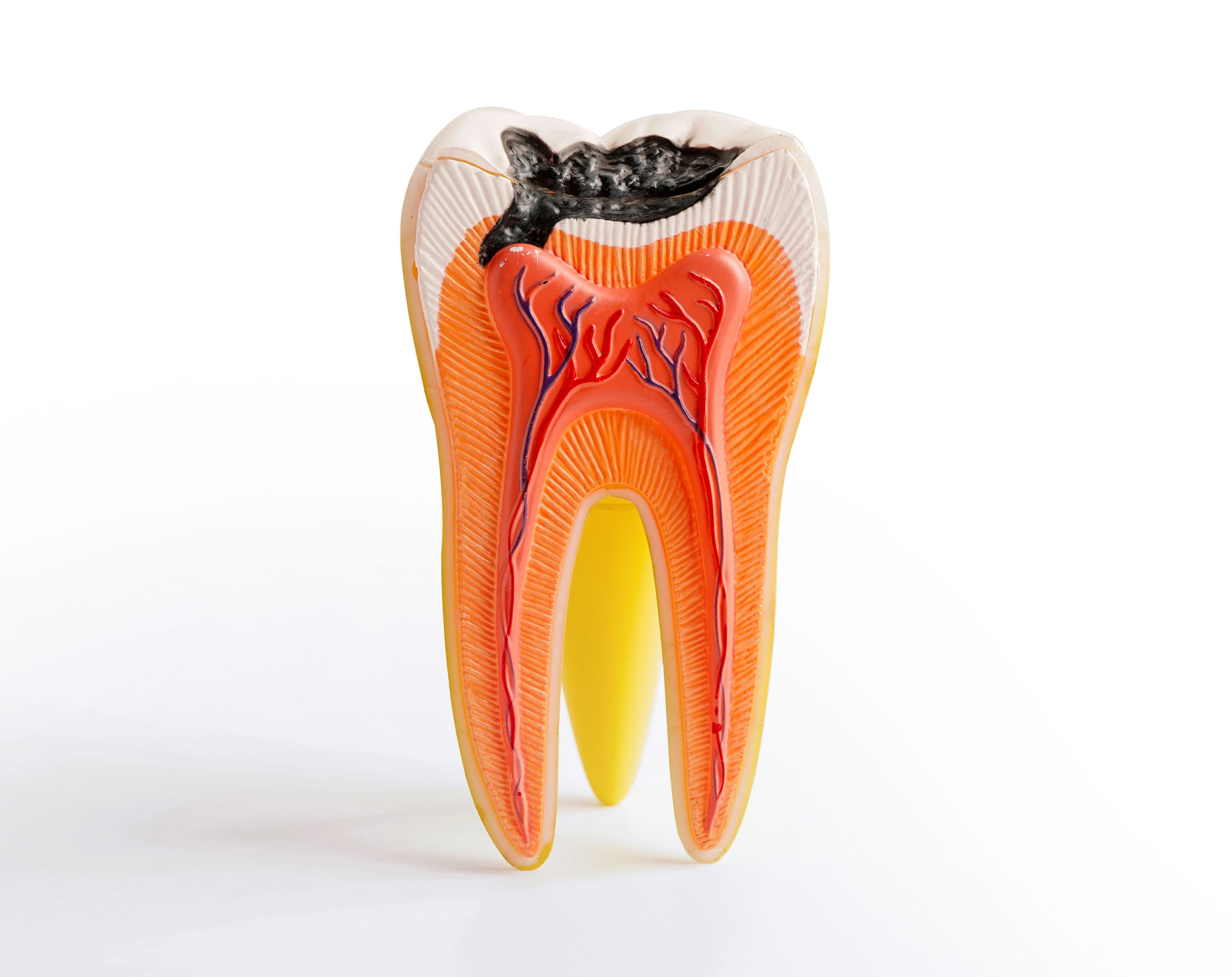 A cross-section model of a tooth showing the root canals extending through the center