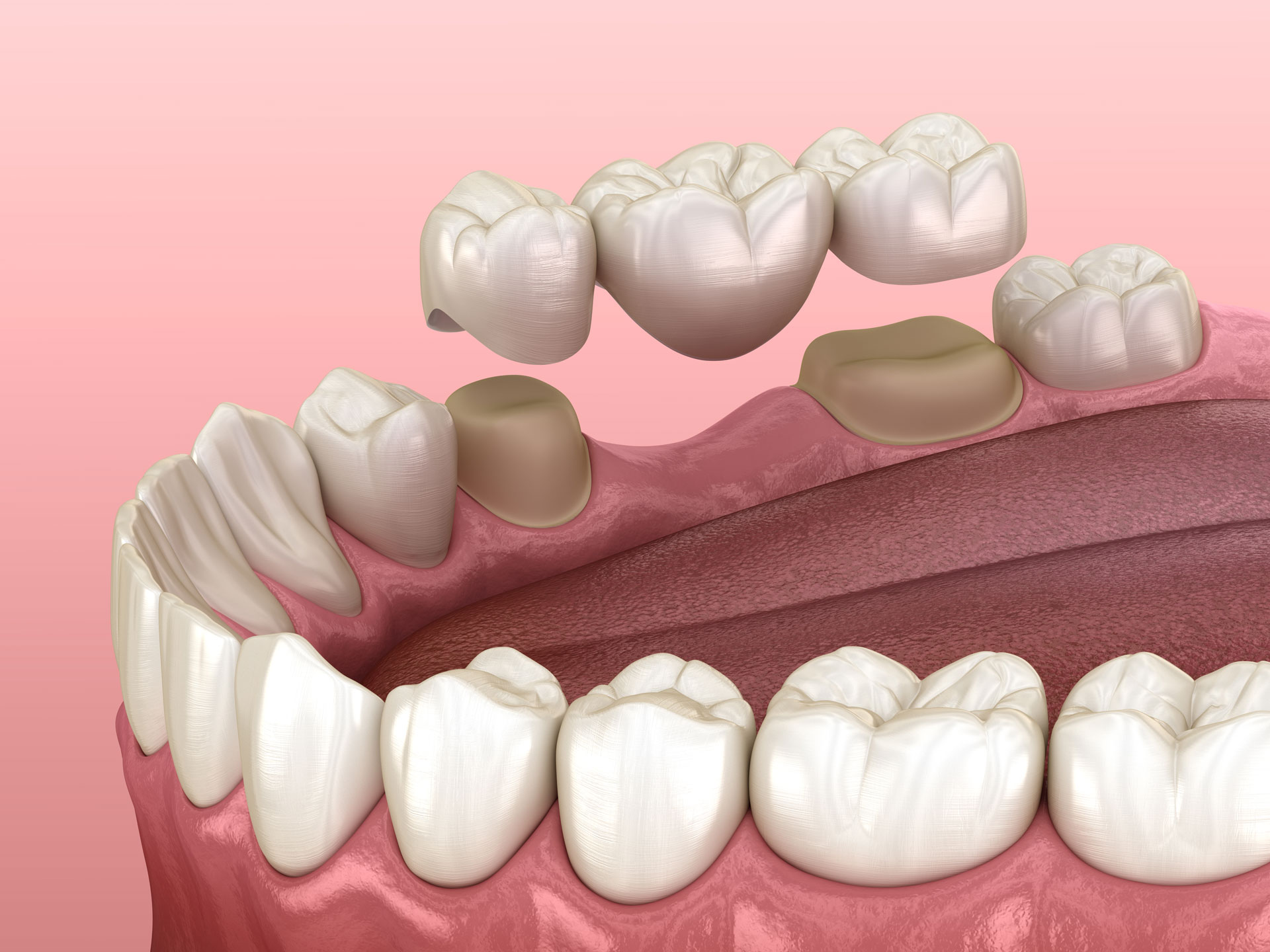 A 3D illustration of a dental bridge being placed over two prepared teeth, replacing missing teeth in the upper jaw