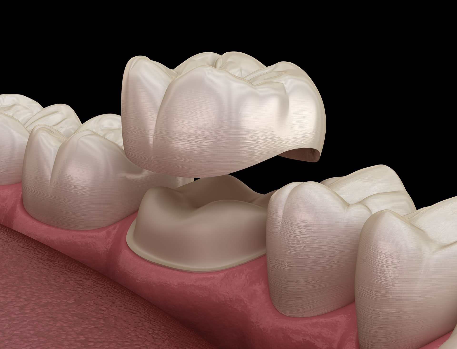 A 3D illustration shows a dental crown being placed over a prepared tooth, restoring its shape and function