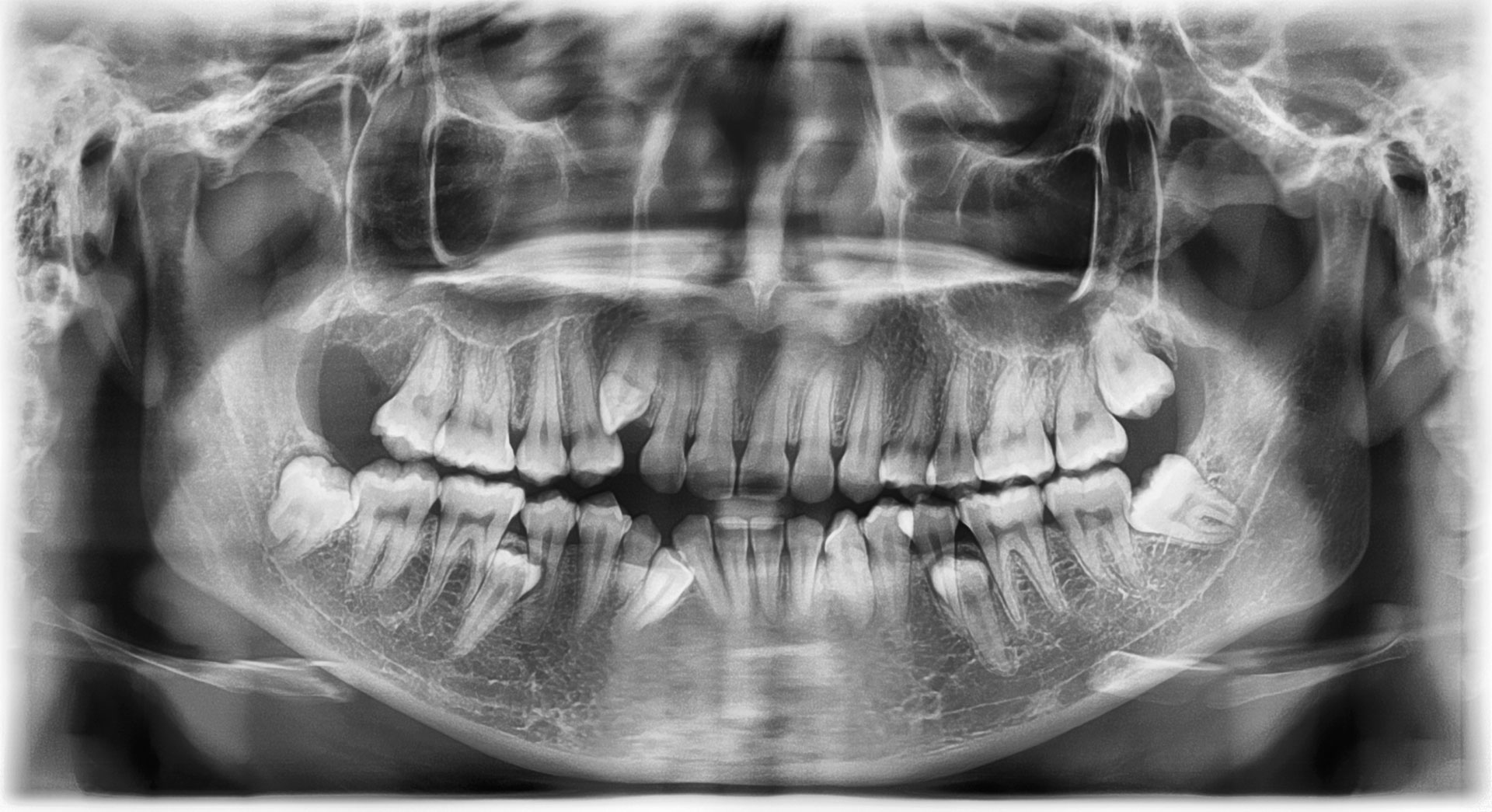 A dental panoramic X-ray showing fully developed teeth, including impacted wisdom teeth, suggesting the need for extraction