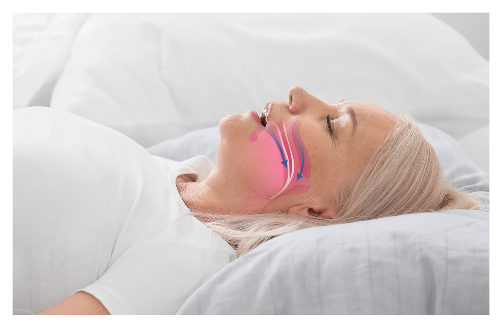 A woman lying on her back with airflow pathways shown, representing dental sleep appliance use for sleep apnea