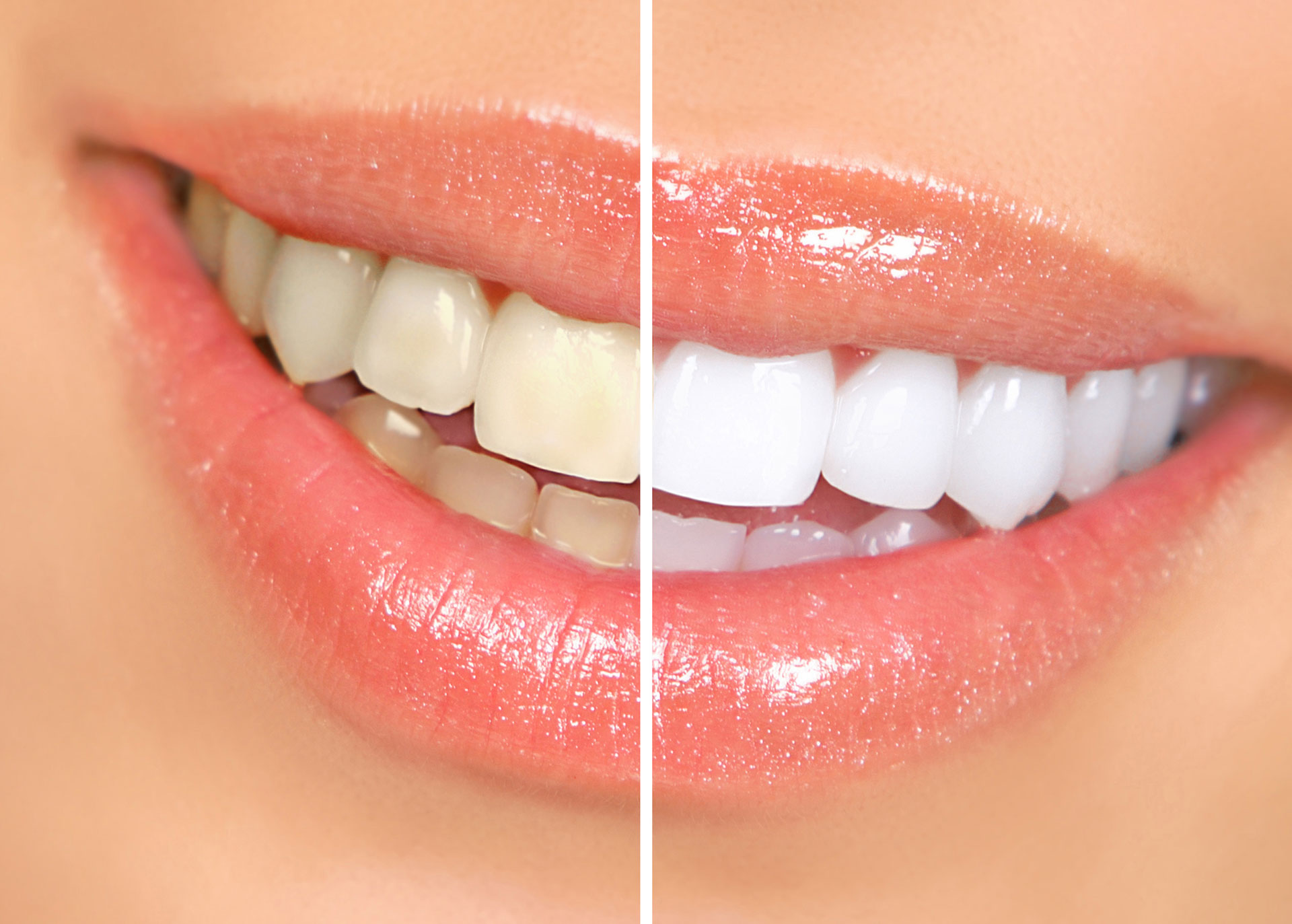 A side-by-side comparison of teeth before and after teeth whitening, showing a transformation from yellowed to bright white teeth