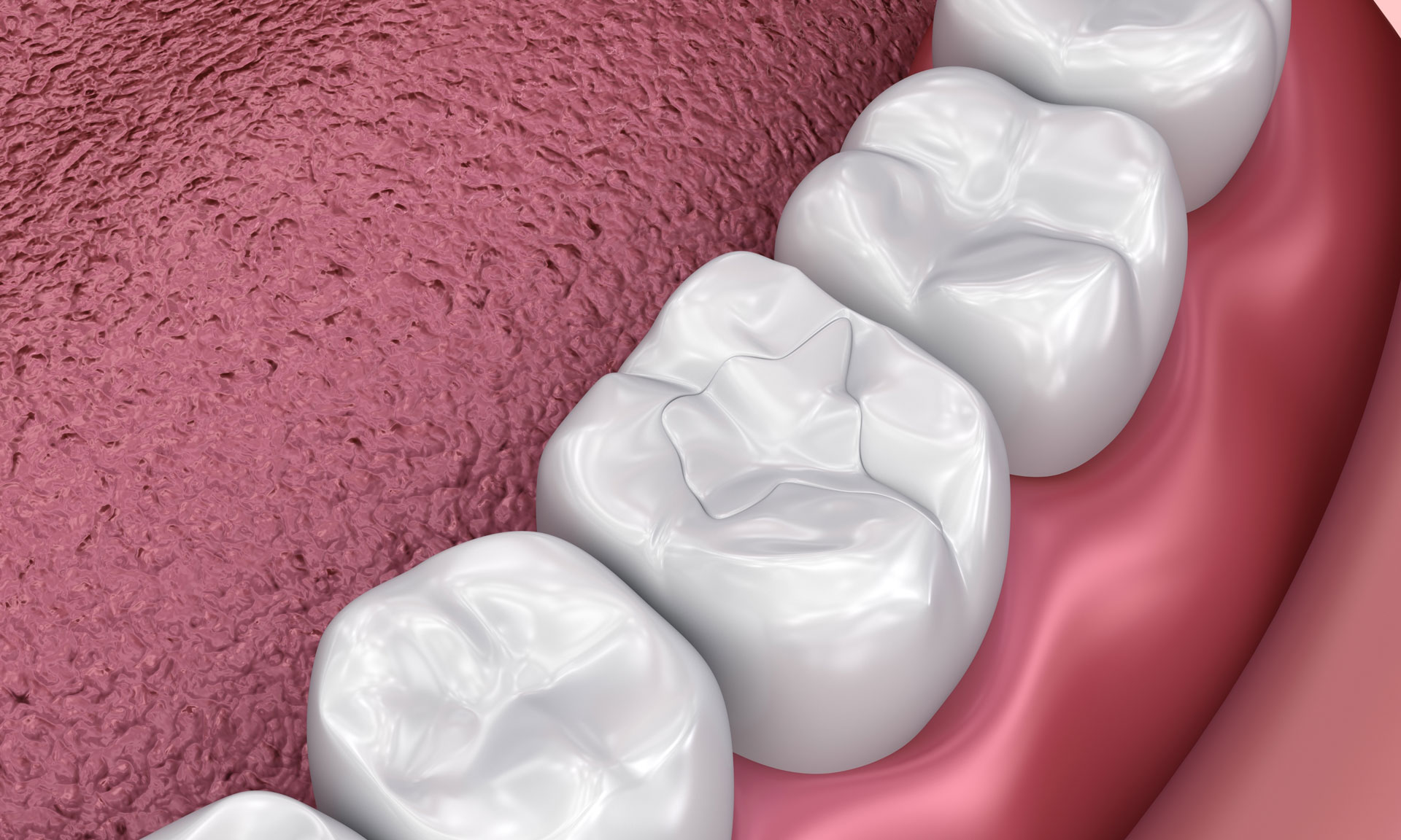 A close-up digital illustration of molar teeth with a tooth-colored filling applied