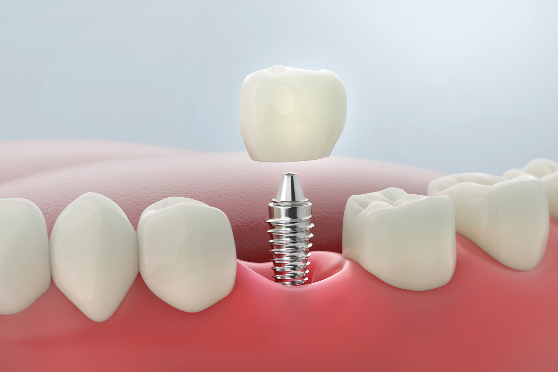 A 3D illustration of a dental implant shows a titanium screw in the gum with a crown being placed on top to replace a missing tooth