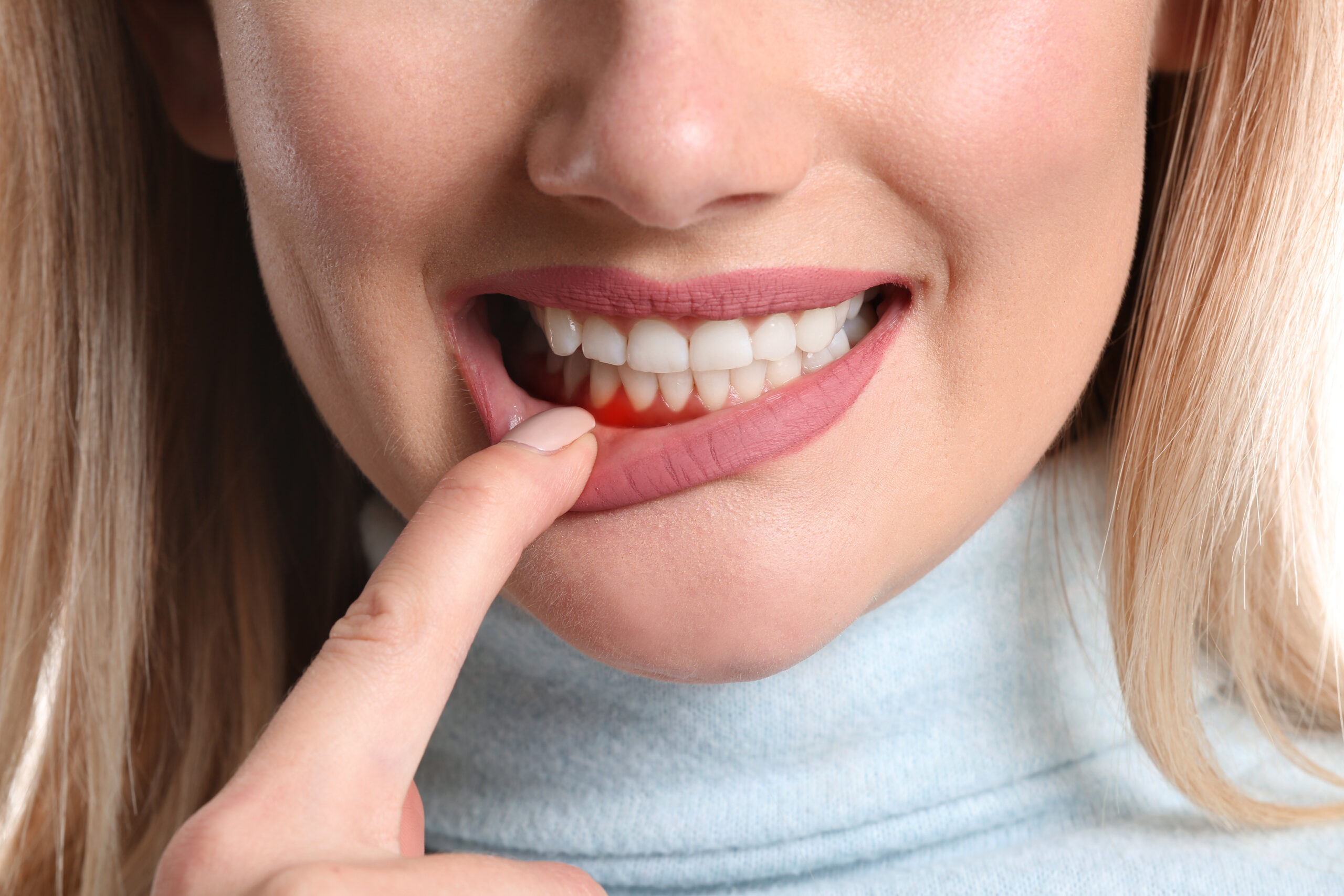 A person gently pulling down their lower lip to reveal red, highlighting the need for periodontal therapy